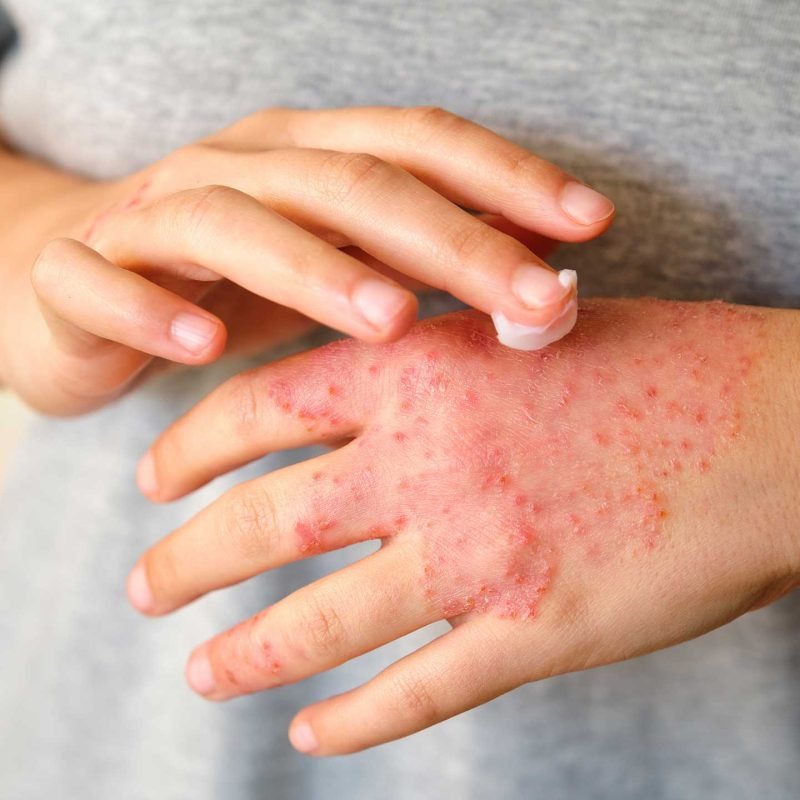 dermatitis-atopica