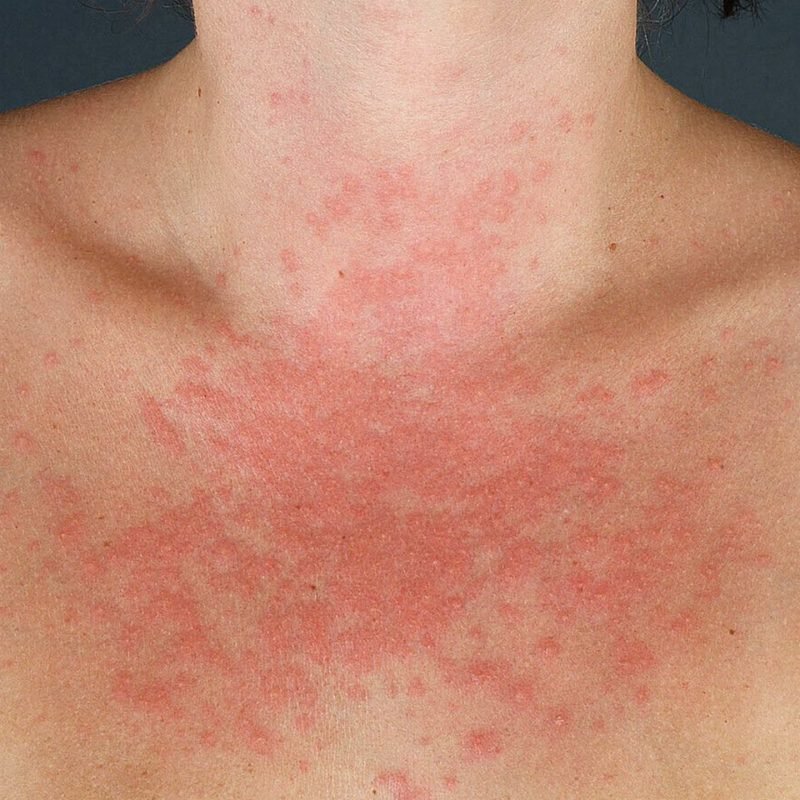 fotodermatitis