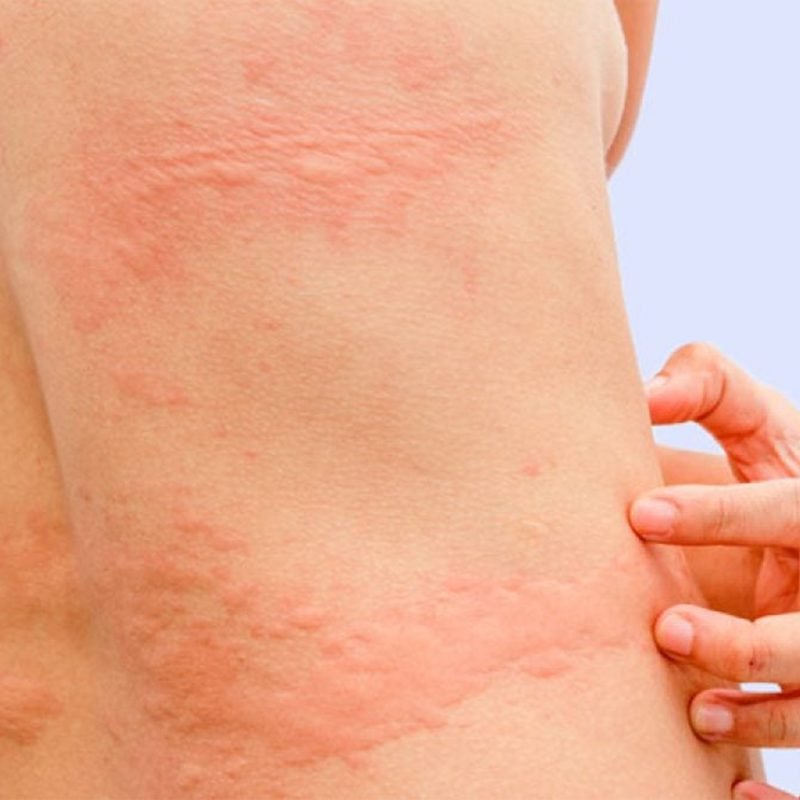 urticaria-en-la-piel
